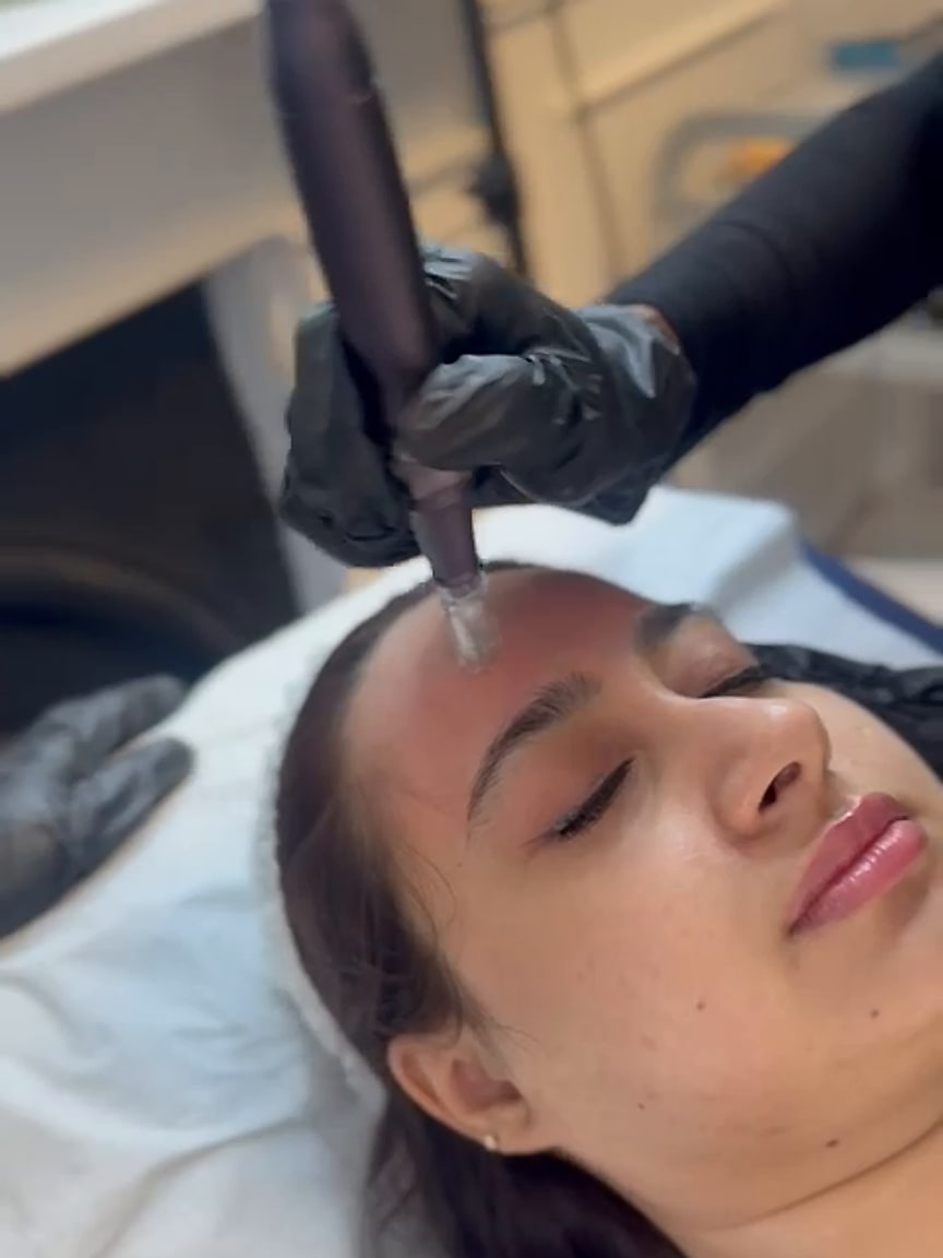 Derma-Pen Microneedling